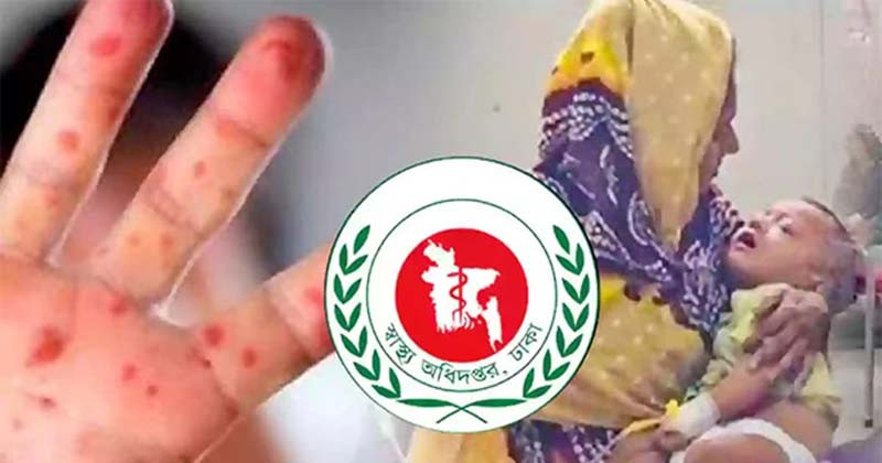 হামের উপসর্গ নিয়ে ৫ শিশুর মৃত্যু
