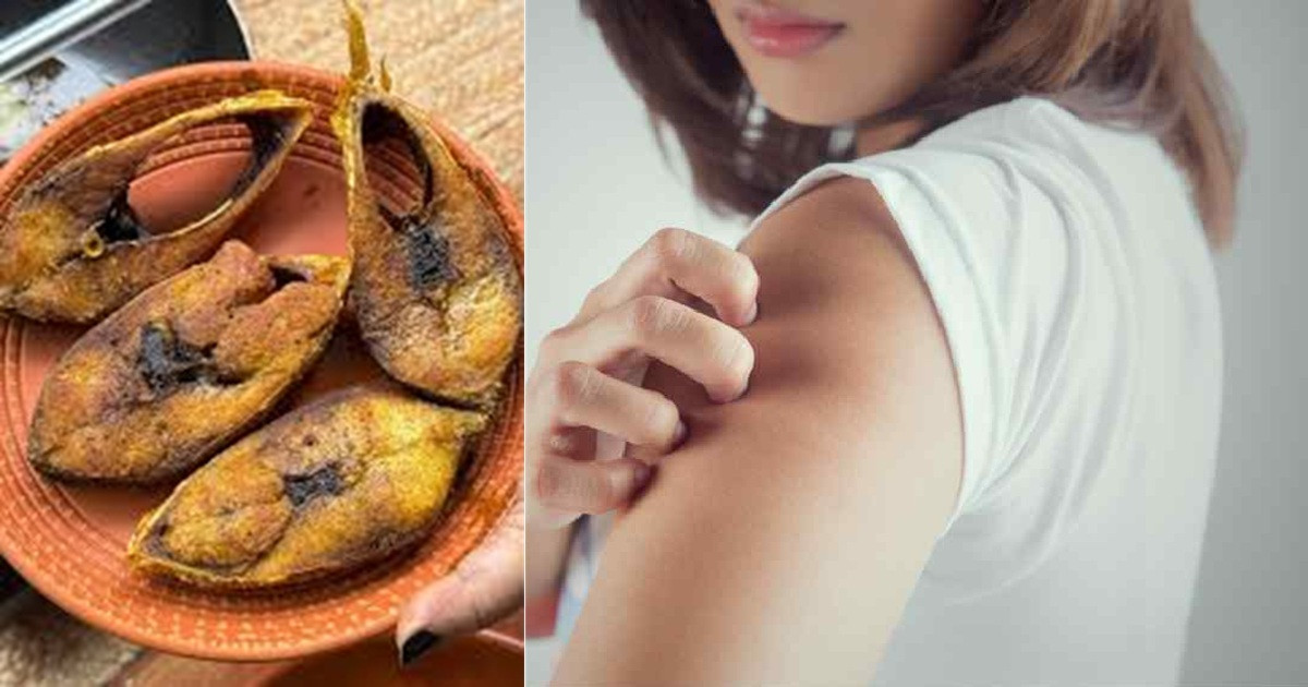 ইলিশ খেয়ে অ্যালার্জি হলে কী করবেন