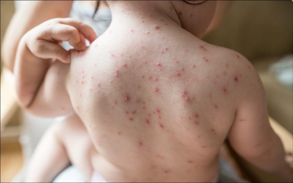 ফরিদপুরে হাম রোগে আক্রান্ত সাত মাসের শিশুর মৃত্যু