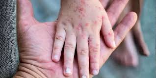 সিলেটে হাম উপসর্গ নিয়ে গত ২৪ ঘণ্টায় তিন শিশুর মৃত্যু