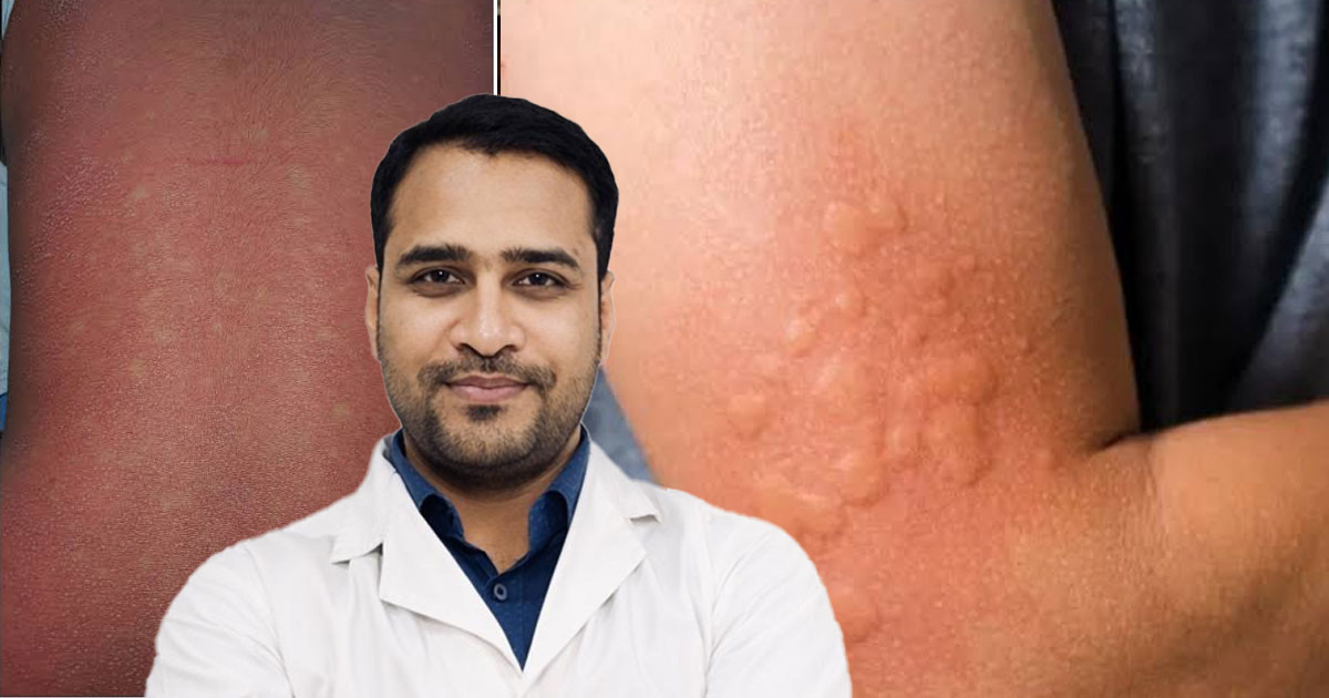 সব র‍্যাশই হাম নয়-লক্ষণ বুঝে আতঙ্ক এড়ানোর পরামর্শ