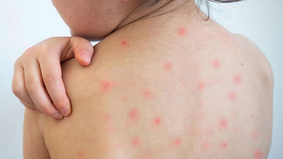 ১৯ দিনে হামের উপসর্গ নিয়ে প্রাণ হারাল ৯৪ শিশু