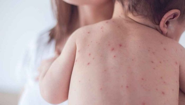 সিলেটে হামের উপসর্গ নিয়ে আরো এক শিশুর মৃত্যু